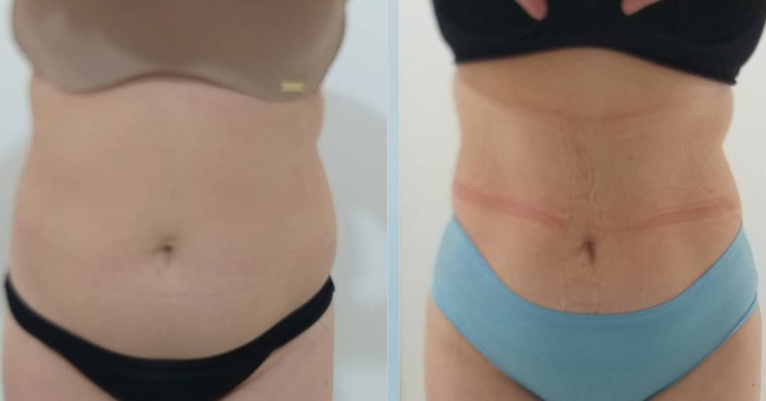 Evolução do tratamento de crio - Foto 6